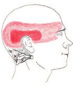 gnykowych) Terapia punktów spustowych w napięciowych bólach głowy W NBG zwykle należy zlokalizować następujące