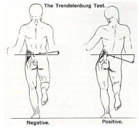 Test Trendelenburga-Duchenne a Badający stoi za pacjentem obserwując kąt zawarty między miednicą, a podłożem.