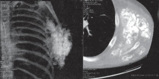 Anna Szumera-Ciećkiewicz, Wapnienie guzowate A B Rycina 2. Obraz guza w tomografii komputerowej (A) wraz z rekonstrukcją 3D (B) Figure 2.