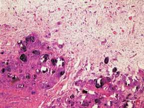 ONKOLOGIA W PRAKTYCE KLINICZNEJ 2011, tom 7, nr 6 A C B D Rycina 3. Obraz mikroskopowy wapnienia guzowatego. A. Fragmenty tkanki włóknistej ze zwapnieniami, 10 ; B.