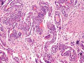 Pozytywne barwienie na obecność CD68, charakterystyczne dla wielojądrowych histiocytów 20 Figure 3. Microscopic characteristic of tumoral calcinosis. A.