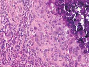 CD68 positive multinucleated histiocytes, 20 Tabela 1. Podział i cechy charakterystyczne pozaszkieletowego wapnienia tkanek miękkich Table 1.