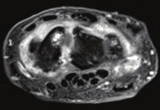 Reumatoidalne zapalenie stawów w badaniu MR i ultrasonografii A B Ryc. 1. Badanie MR, obraz T1-zależny, TSE FS (Time Spine Echo, Fat Sat) po podaniu środka kontrastującego: A.