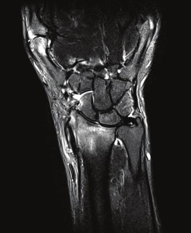 Reumatoidalne zapalenie stawów w badaniu MR i ultrasonografii magnetyczny.