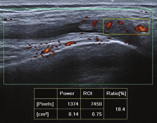 We wczesnym RZS badanie MR uwidacznia nadżerki kostne u 45 72% pacjentów z chorobą trwającą krócej niż 6 miesięcy (1), a w przypadku radiografii odsetek ten wynosi 8 40%.