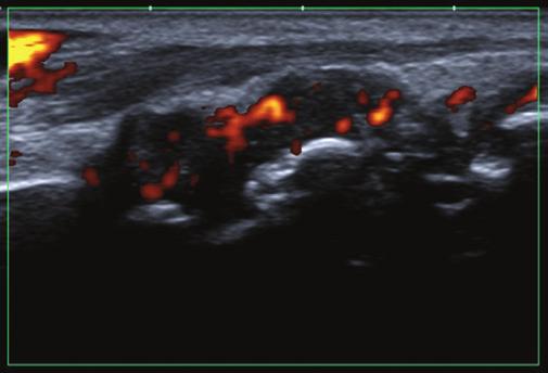 Reumatoidalne zapalenie stawów w badaniu MR i ultrasonografii A B Ryc. 11. Badanie MR: A. płaszczyzna czołowa, obraz T1-zależny, TSE FS (Time Spine Echo, Fat Sat) po podaniu środka kontrastującego, B.