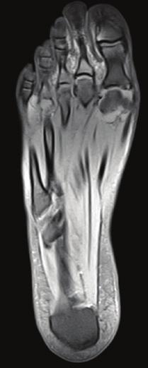 Do zmian typowych dla RZS w tej lokalizacji zalicza się: podwichnięcie w stawie szczytowo-obrotowym (atlanto-axial subluxation, AAS), podwichnięcia okolicy podszczytowej (subaxial subluxation, SSA),