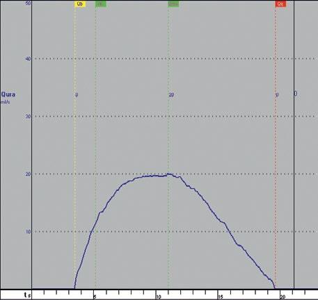 mikcji Q ave = V/T (ml/s), czas od rozpoczęcia mikcji do osiągnięcia maksymalnego przepływu T Qmax (s), czas mikcji od rozpoczęcia do zakończenia mikcji, uwzględniający ewentualne przerwy w ciągłości