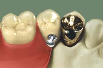 DC Microlock rygiel (tytan) Mały, wymienialny, stabilny wciskowy rygiel. Wykonany na wysoko precyzyjnych, nowoczesnych CNC- maszynach.