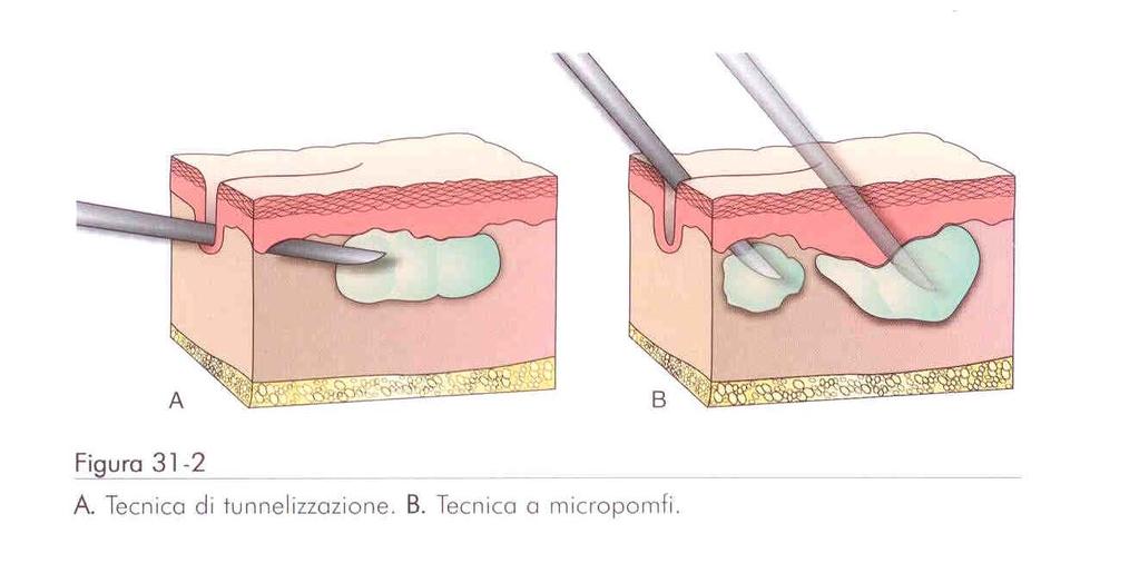 Technika tunelowa