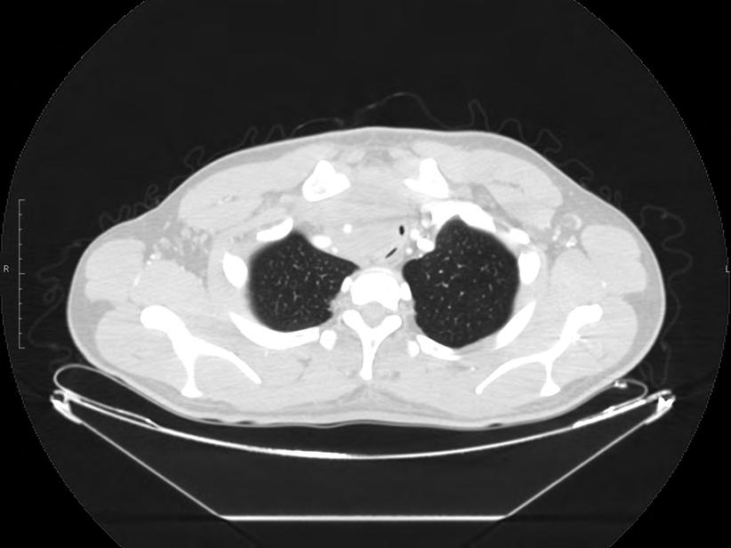 Tumor progression, narrowing of the trachea becomes critical Guz miał twardą strukturę i był nieprzesuwalny względem podłoża.