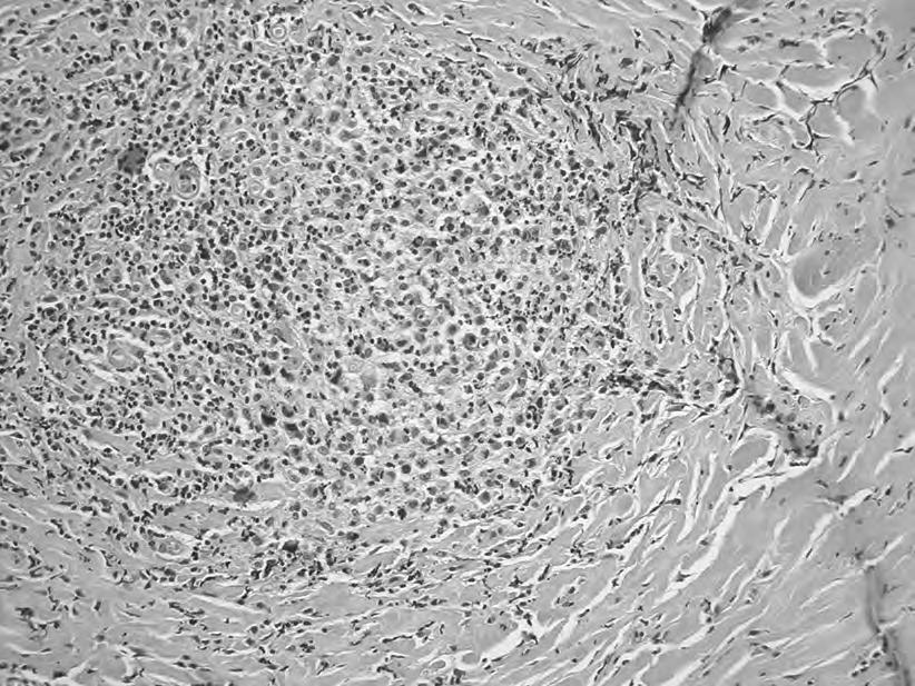 Pneumonologia i Alergologia Polska 2014, tom 82, nr 2, strony 150 155 Rycina 6. Naciek limfoidalny, w obrębie którego widoczne są duże, atypowe komórki typu Hodgkina Figure 6.