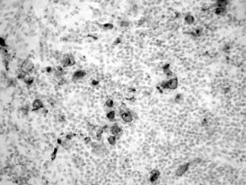 Immunohistochemical reaction with an antibody against CD15 showed the Hodgkin s neoplastic cells (dark) Rycina 7.