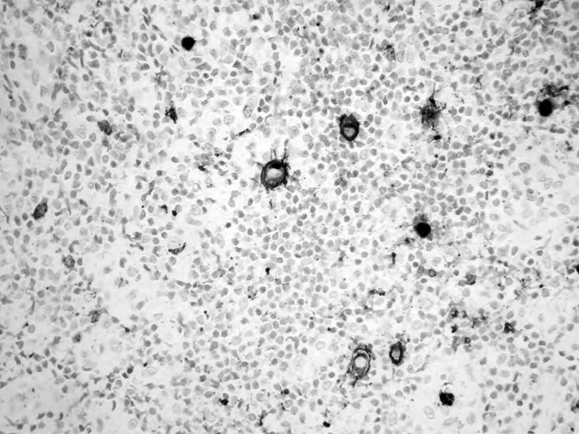 Immunohistochemical reaction with an antibody against CD30 showed the Hodgkin s neoplastic cells (dark) się w każdym narządzie, ale najczęstsza jest postać szyjno-twarzowa i brzuszno-miedniczna.