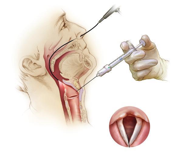 Thyrohyoid Approach (cont) Needle