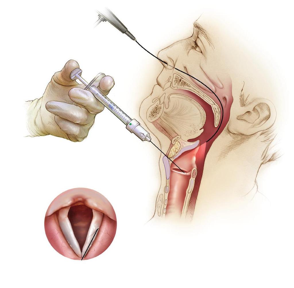 Thyrohyoid Approach (cont)