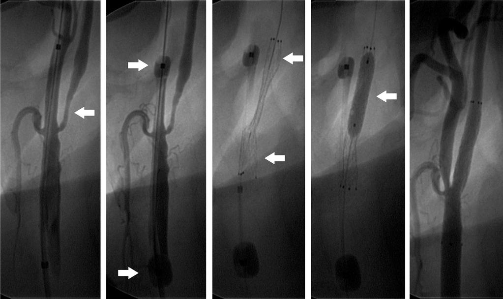 isotonic saline before the procedure. In all patients carotid artery stenting was performed with the use of cerebral protection devices.