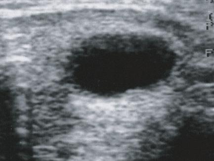 Praca przeglądowa Endokrynol. Ped., 2/2003;3(4):65-70 Fig. 1. Ultrasound imaging of thyroid nodular disease: a. nodule in congenital hypothyroidism, b. cystic nodule, c. hyperplastic nodule, d.
