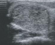 Obraz ultrasonograficzny choroby guzkowej tarczycy: a guzek we wrodzonej niedoczynności tarczycy, b guzek torbielowaty, c guzek rozrostowy, d postać atypowa gruczolaka pęcherzykowego, e rak