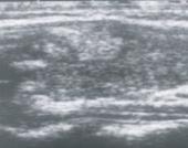 wynikiem odmienności molekularnej tkanki guza [22]. W literaturze istnieje określenie follicular adenoma with an undetermined prognosis [23].
