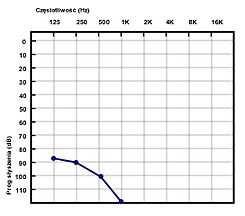 RESZTKI SŁUCHU URAZ AKUSTYCZNY NIEDOSŁUCH
