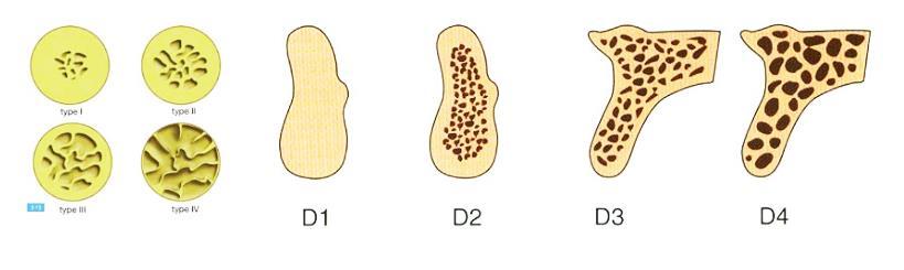 Klasyfikacja kości, Protokół nawiercania, Osteotomia implantu Wysoki wskaźnik sukcesu przy zastosowaniu implantów zębowych spowodował, że stomatolodzy zaczęli częściej wybierać tę metodę leczenia