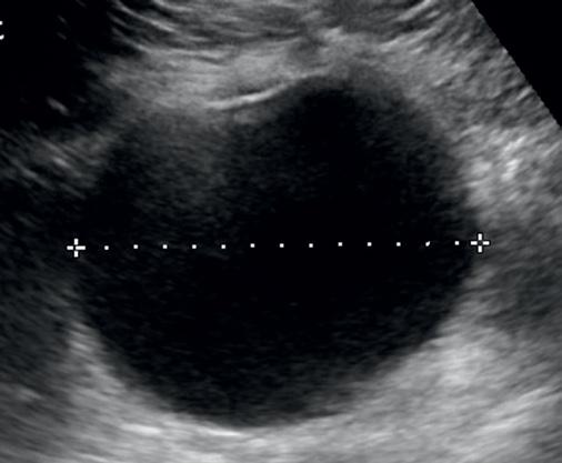 Pomyłki w diagnostyce ultrasonograficznej jamy brzusznej w pediatrii Ryc. 2.