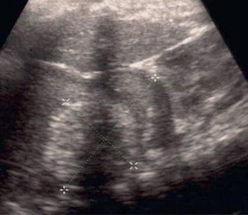 Pomyłki w diagnostyce ultrasonograficznej jamy brzusznej w pediatrii Ryc. 8. Trzustka małego dziecka prawidłowa, niskoechogeniczna Ryc. 9.