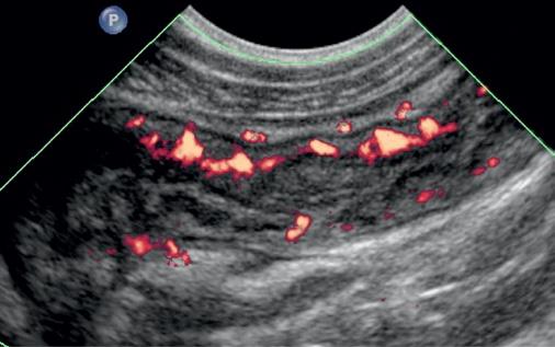 Pomyłki w diagnostyce ultrasonograficznej jamy brzusznej w pediatrii Ryc. 14.. Pogrubiała ściana końcowego odcinka jelita krętego ze wzmożonym przepływem naczyniowym;.