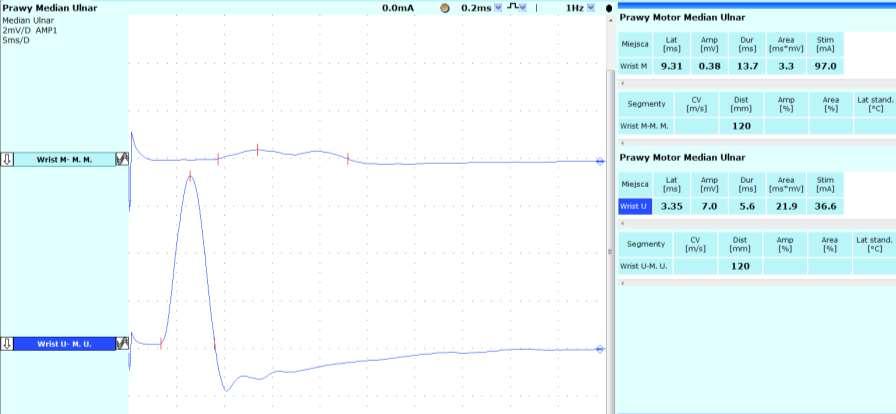porównanie latencji odpowiedzi ruchowych z mięśnia glistowatego II i