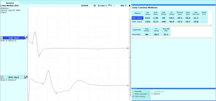 przewodzenie we włóknach czuciowych nerwu pośrodkowego u pacjenta z niewielkim zespołem cieśni nadgarstka: rejestracja odpowiedzi na II palcu, stymulacja