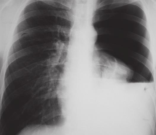 Pneumonologia i Alergologia Polska 2011, tom 79, nr 2, strony 127 131 Wprowadzenie Odma opłucnowa jest jednym z najczęściej spotykanych stanów nagłych w pneumonologii.