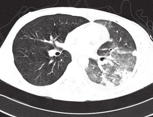 Left lung lesions are increased, now occupying the whole lung B dzono obecność jednostronnych zmian o typie matowej szyby w lewym płucu (ryc. 4). Chorego leczono antybiotykami i.v. i tlenem 3 l/min.