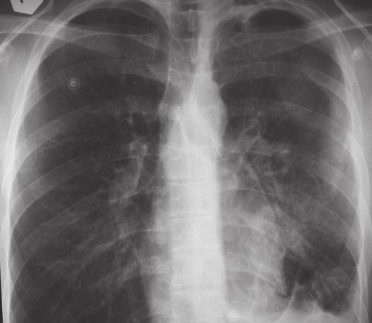 Pneumonologia i Alergologia Polska 2011, tom 79, nr 2, strony 127 131 Tabela 1. Zmiany w badaniach laboratoryjnych stwierdzone w trakcie hospitalizacji Table 1.