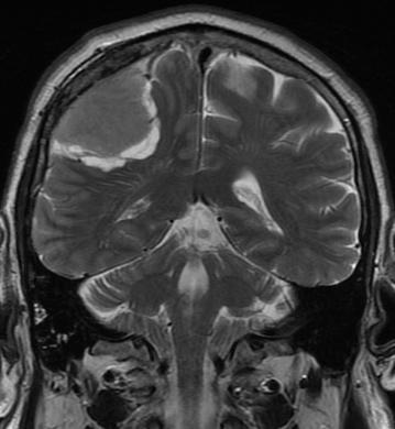 Meningioma