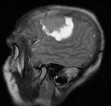 Meningioma