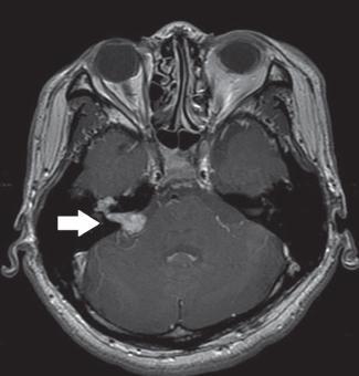 Nerwiak n. VII * Chen et al.