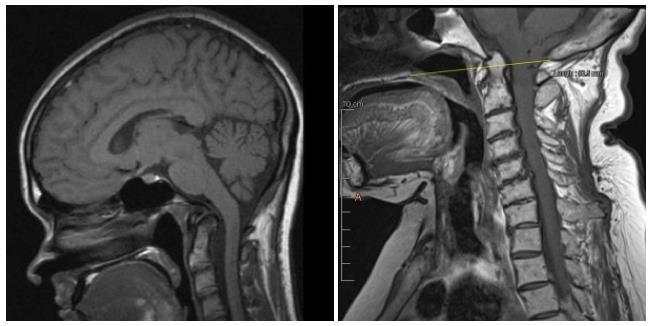 Parametry radiologiczne połączenia czaszkowo- kręgowego 2 4 1 3 1 Linia McRae 2