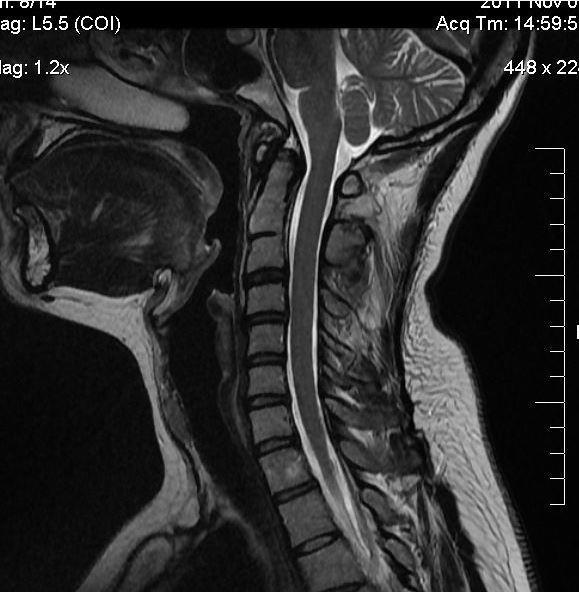 Badanie MRI górnego piętra szyjnego częściowy blok kostny C2/C3