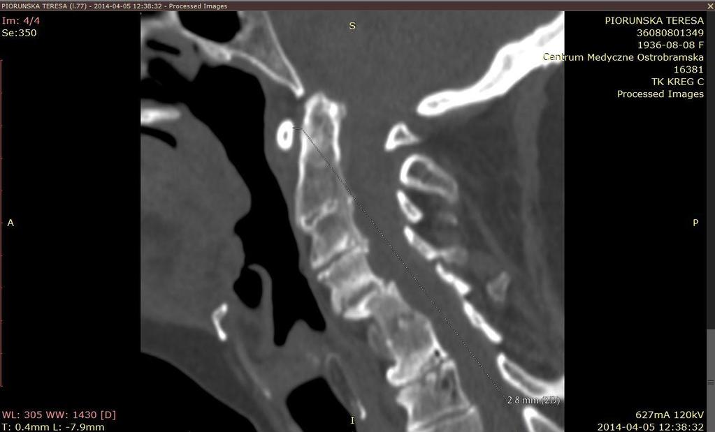 Tomografia komputerowa wgłobienie podstawne, migracja C2 w