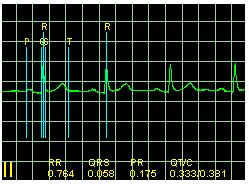 Dodatkowo do przebiegu sygnału EKG, odcinki pojawiają się ze znacznikami P, Q, R, S oraz T lub znacznikami ST (izoelektryczny, punkt J i S), w zależności która z opcji (QRS czy Znaczniki ST) jest