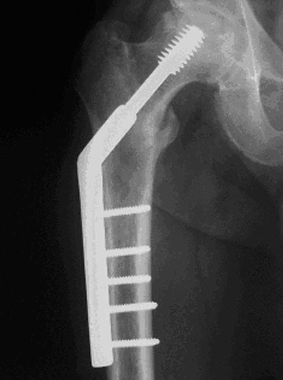 Tabela X Kryteria Golca oceny radiologicznej wyników leczenia operacyjnego z³amañ oko³okrêtarzowych koœci udowej z zastosowaniem DSB.