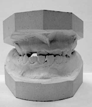 Occlusal adjustment was performed three times during treatment: to produce inclined surfaces on the left canines and to eliminate prematural contacts on the right and left canines.