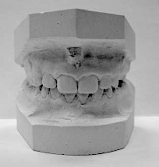 The treatment was accomplished after 10 months. Occlusal adjustment was proceeded with high- -speed turbine with water spray and fine diamond bur in all cases. Local anaesthesia was not necessary.