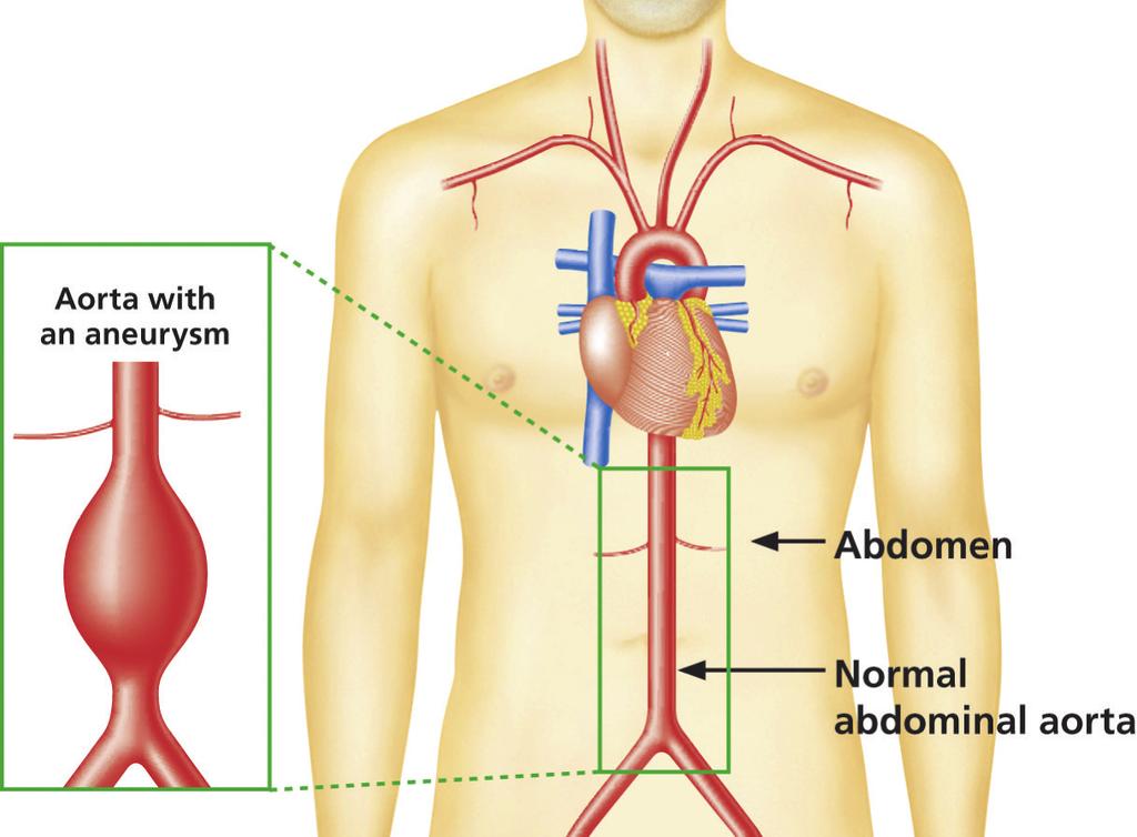 Wynik Twojego badania przesiewowego Zauważyliśmy, że część Twojej aorty jest szersza, niż powinna być. Oznacza to, że masz średniej wielkości tętniaka aorty brzusznej (ang.