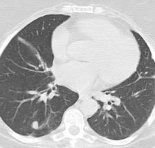 Pneumonologia i Alergologia Polska 2012, tom 80, nr 3, strony 269 274 W pracy zaprezentowano przypadek 59-letniej chorej, u której w 1993 roku rozpoznano złośliwego MPNST, tkanek miękkich grzbietu