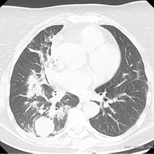 CT scan (February 2009) shows slight regression of the tumour in right lung, size of tumour 40 38 40 mm, around the changes post radiation pneumonitis appeared nę klatki piersiowej uzyskano