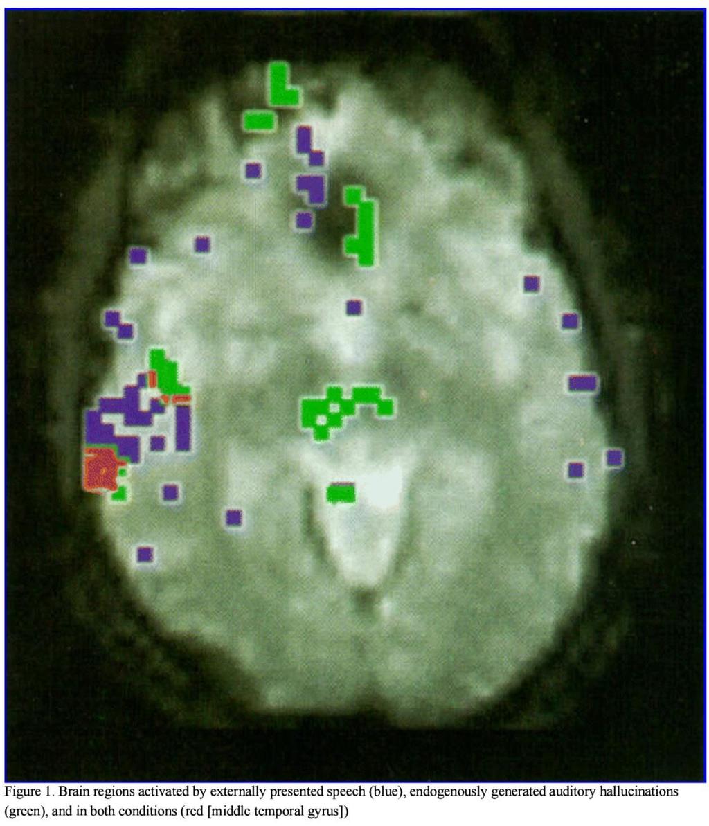 Schizofrenia