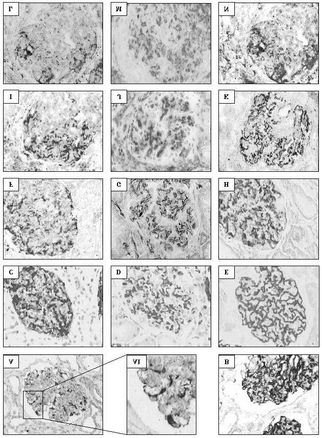 250 Z. I., NIEMIR, P. OLEJNICZAK, G. DWORACKI Fig. 2. A, A1 the immunoreactivity for IL 8E in a normal glomerulus.