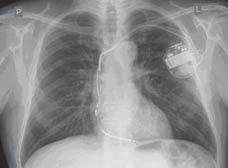 Po konsultacji kardiochirurgicznej zdecydowano o odroczeniu decyzji dotyczącej zabiegu operacyjnego usunięcia ICD.